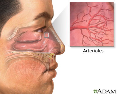 What Causes A Nosebleed In One Nostril?