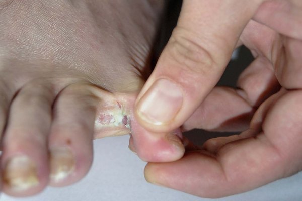 What Is The Strongest Treatment For Athlete'S Foot