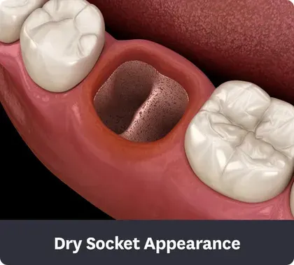 What Does A Dry Socket Look Like