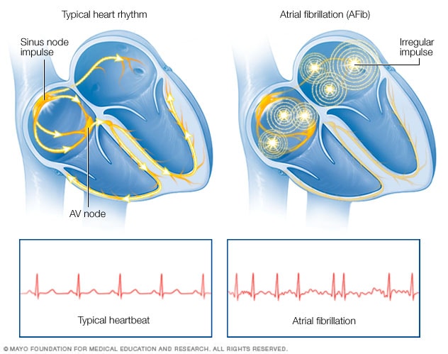 What Is A Dangerous Heart Rate With Afib