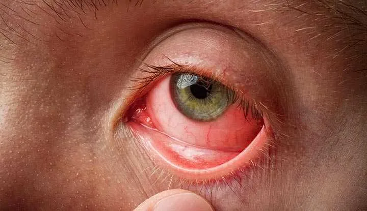 What Is Commonly Misdiagnosed As Pink Eye