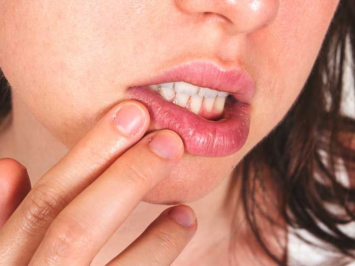 What Does A Cold Sore Look Like