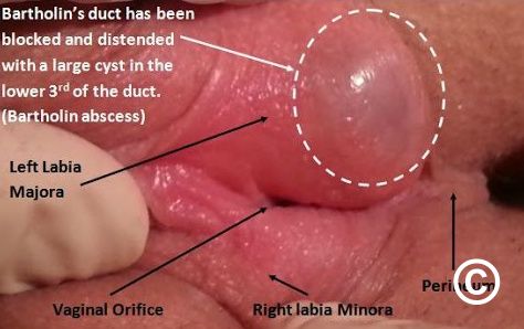 What Does A Bartholin Cyst Look Like Pictures