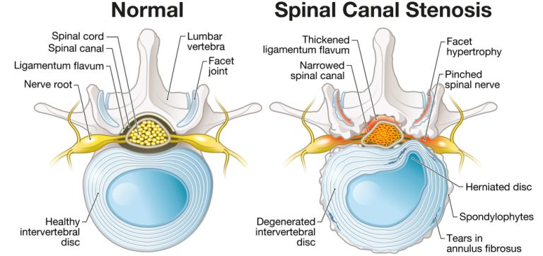 What Is The Newest Treatment For Spinal Stenosis?