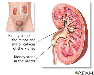 What Does A Kidney Stone Feel Like