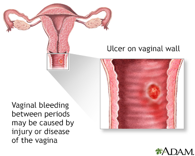 What Does It Mean When Your Bleeding