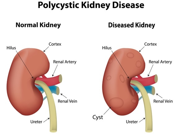 What Size Of Kidney Cyst Is Dangerous