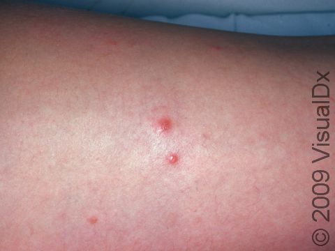 What Does A Bed Bug Bite Look Like