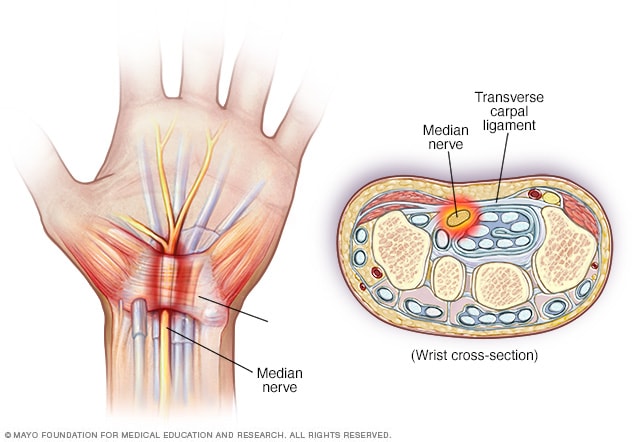 What Does A Pinched Nerve Feel Like