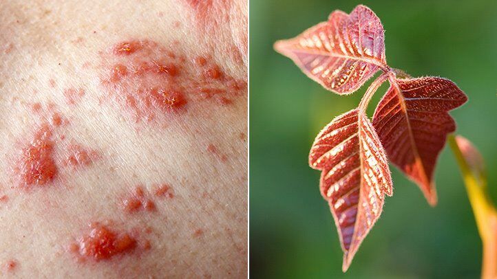 What Does Poison Ivy Rash Look Like