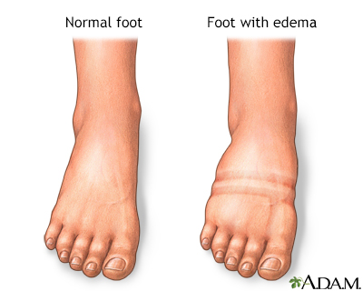 What Is Swollen Ankles A Sign Of