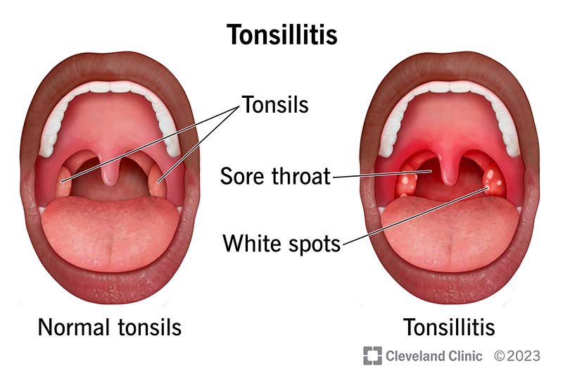 What Does A Sore Throat Look Like