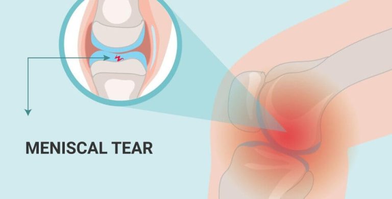 What Does A Torn Meniscus Look Like On The Outside